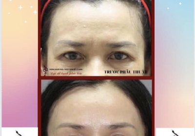 Căng trán thái dương- giải pháp cực hiệu quả để giải quyết dấu vết của tuổi già nửa trên khuôn mặt