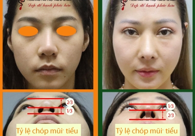 Những ưu điểm của chỉnh hình mũi tái cấu trúc so với kỹ thuật đặt sống mũi đơn thuần 