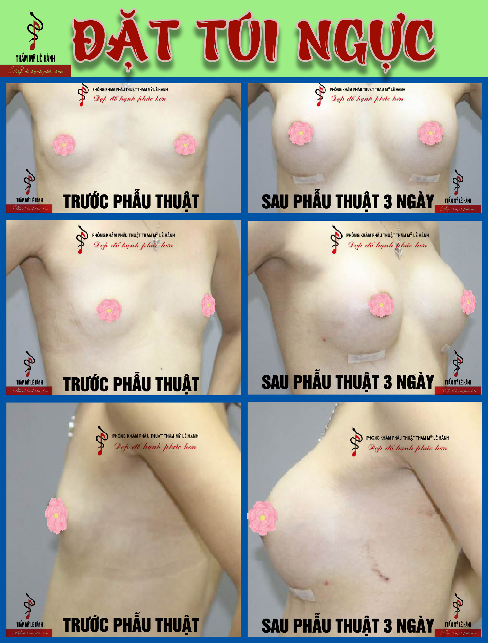 Đặt túi ngực và những điều bạn có thể chưa biết!