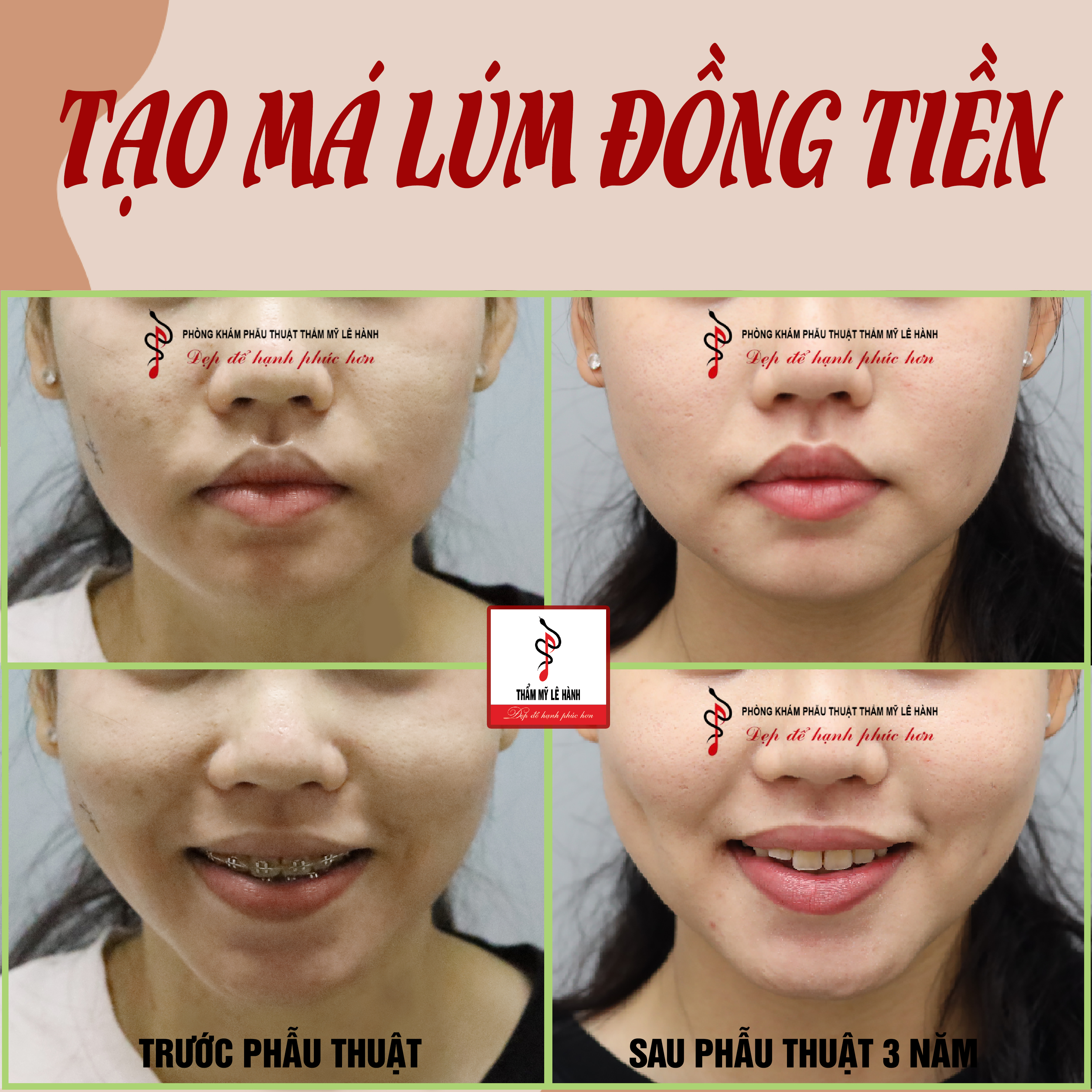 Tạo má lúm đồng tiền