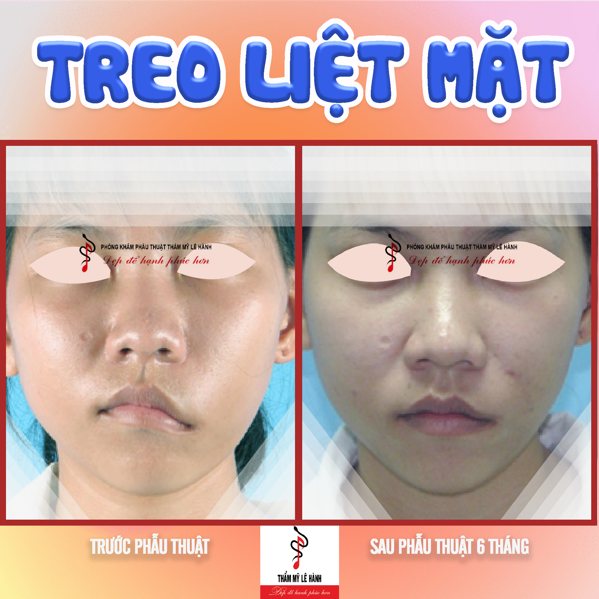 Giải pháp nào để cải thiện "liệt thần kinh mặt"?