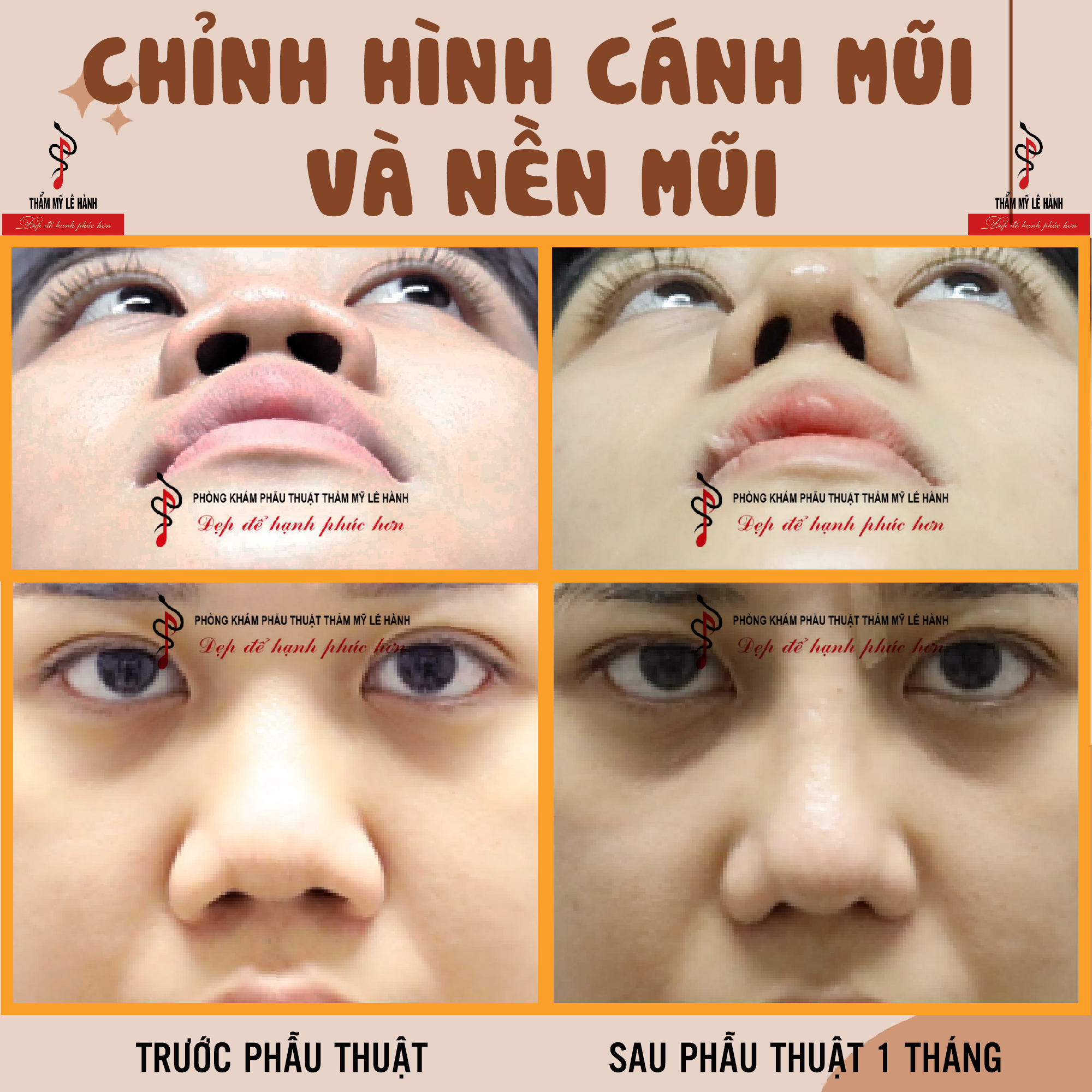 Tầm quan trọng của chỉnh hình cánh mũi và nền mũi