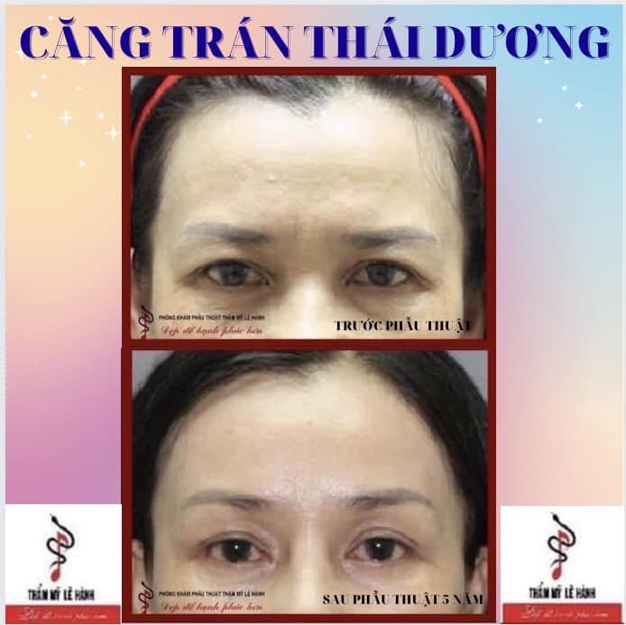 Căng trán thái dương- giải pháp cực hiệu quả để giải quyết dấu vết của tuổi già nửa trên khuôn mặt
