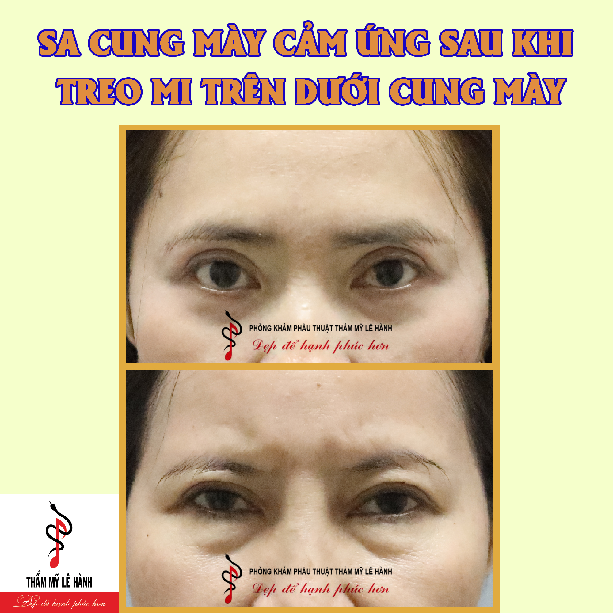 SA CUNG MÀY CẢM ỨNG SAU KHI TREO MI TRÊN DƯỚI CUNG MÀY