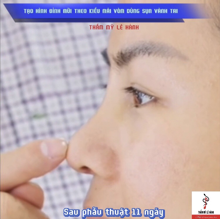 Tạo hình đỉnh mũi theo kiểu mái vòm dùng sụn vành tai