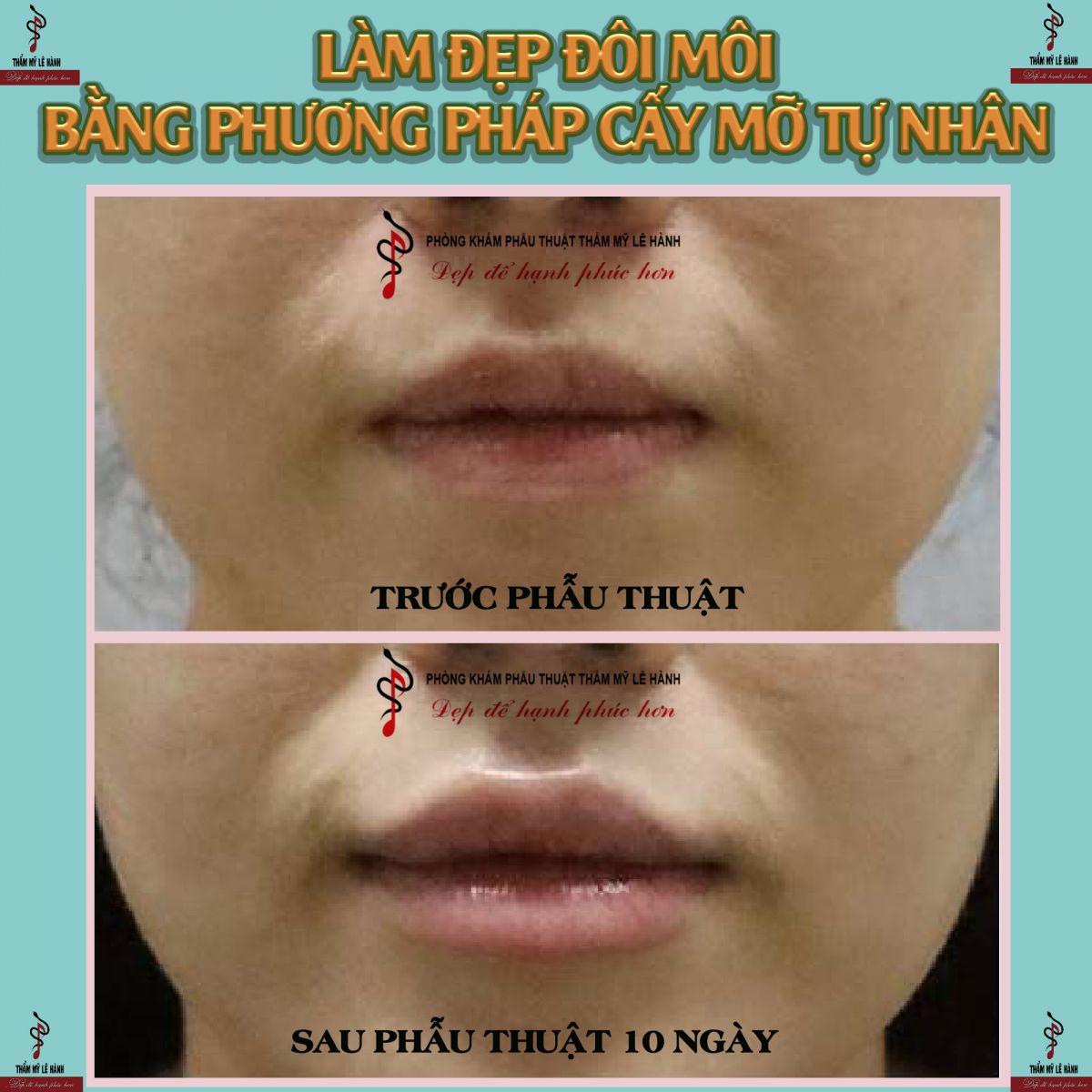 làm đẹp đôi môi bằng phương pháp cấy mỡ tự thân